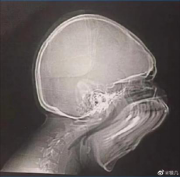 拍牙片時打了個哈欠，變成了毒液？用3D打印技術制作牙齒的好處